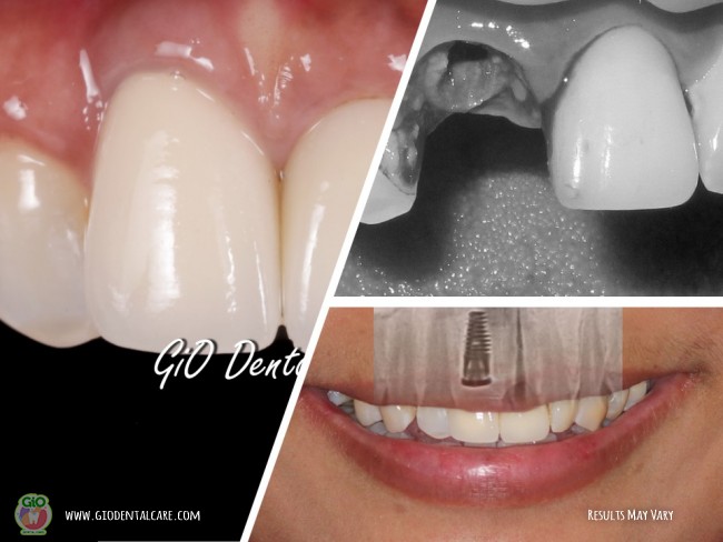 gio-dental-implants-1